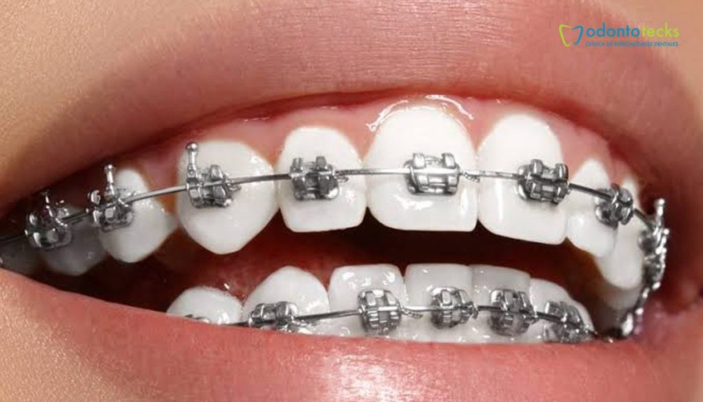 Tratamiento Brackets Tradicionales